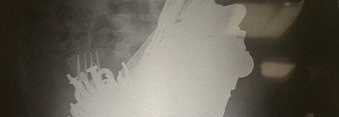IL PAZIENTE STA MALE E VOMITA SANGUE: I MEDICI TROVANO QUALCOSA DI INCREDIBILE - FOTO - 10/06/2015