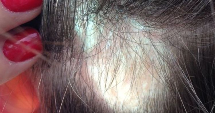 ''NON USATE QUELLO SHAMPOO, RENDE CALVE''. LA DENUNCIA DI CENTINAIA DI DONNE - 17/12/2015