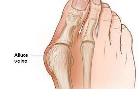 ALLUCE  VALGO: COME RIDURLO ED ELIMINARE IL DOLORE CON UN RIMEDIO NATURALE. ECCO QUAL'E' - 13/05/2015