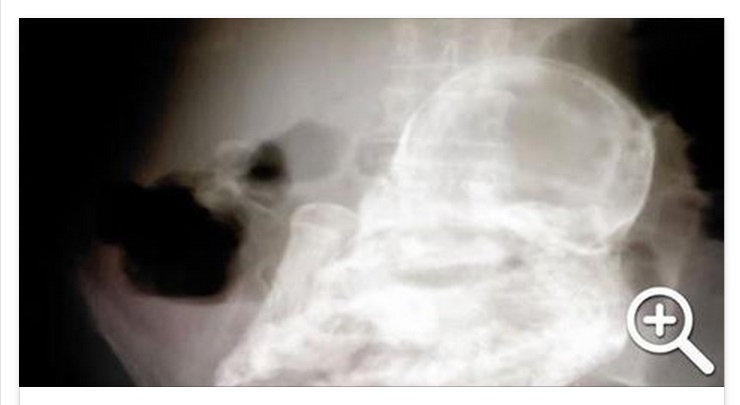 LA 92ENNE VA IN OSPEDALE: QUELLO CHE TROVANO NEL SUO VENTRE LASCIA I MEDICI SCONVOLTI - 21/06/2015