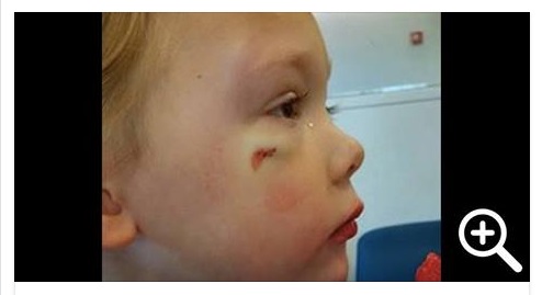 BIMBA DI 4 ANNI PICCHIATA DALL'AMICHETTO, POI LA GIUSTIFICAZIONE DELL'INFERMIERE - 13/10/2015