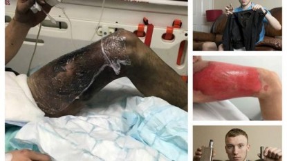 ESPLODE SIGARETTA ELETTRONICA, RISCHIA DI PERDERE LA GAMBA - 21/02/2016