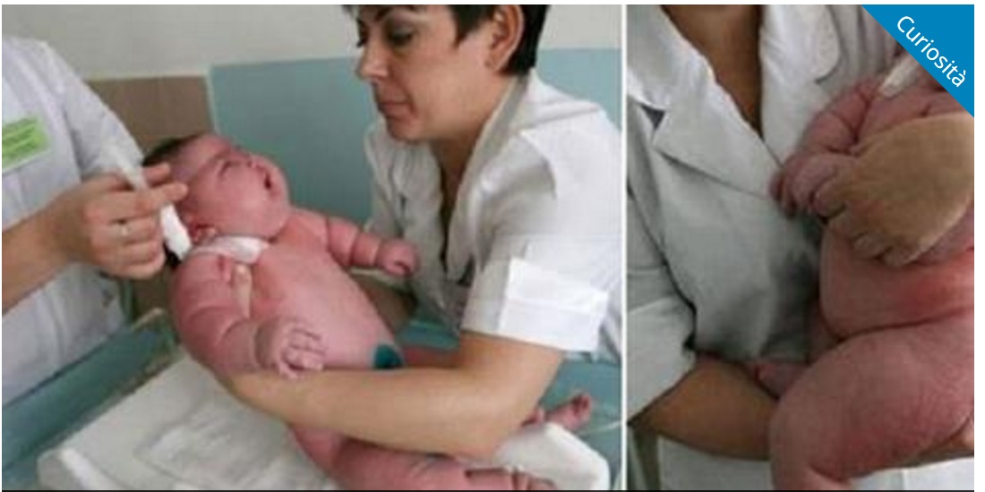 DONNA OBESA DI 300KG PARTORISCE NEONATO DI 40 KG: ASSURDO QUELLO CHE SI SCOPRE - 26/11/2016