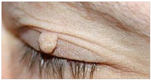 FIBROMI, ECCO COME ELIMINARLI IN MANIERA IMMEDIATA CON UN INGREDIENTE PRESENTE IN TUTTE LE CASE - 30/01/2017