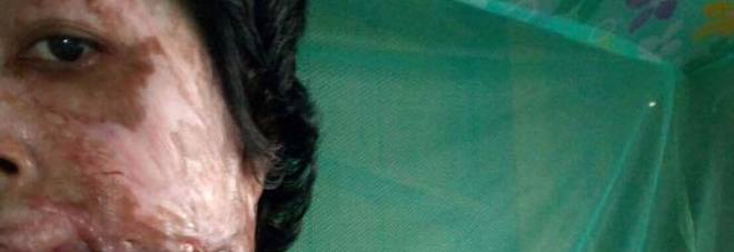 PUBBLICA TRE SELFIE SU FACEBOOK, IL MARITO LE SCIOGLIE LA FACCIA CON LA BENZINA: ''LO PERDONO'' - 05/03/2017
