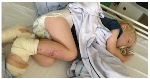 RISCHIA DI PERDERE LE DITA DEI PIEDI MENTRE GIOCA SULLA SABBIA: LA MADRE METTE IN GUARDA I GENITORI - 28/06/2017
