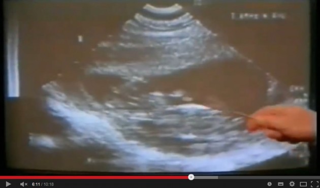 VA AD ABORTIRE IN OSPEDALE MA I MEDICI FANNO UNA SCOPERTA ORRENDA. ECCO COSA HANNO VISTO - 30/04/2015