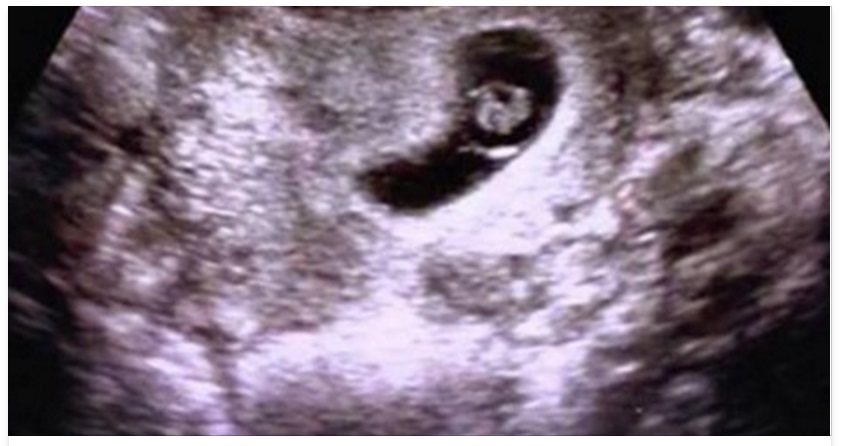 DECIDE DI ABORTIRE, MA 9 SETTIMANE DOPO L'ABORTO LA SCOPERTA SHOCK - 13/03/2016