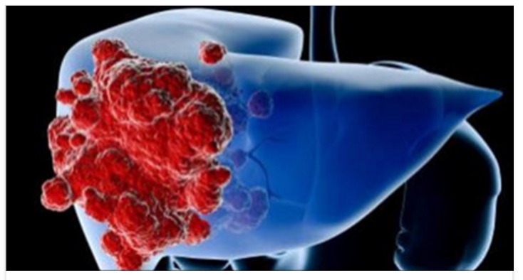 TUMORE, ORMAI E' UFFICIALE ECCO L'ALIMENTO PIU' CANCEROGENO, LO MANGIAMO TUTTI - 25/03/2017