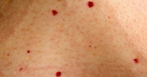ATTENTI AI NEI ROSSI: ECCO COSA NASCONDONO E IN QUALI PARTI DEL CORPO SONO PERICOLOSI - 07/07/2015
