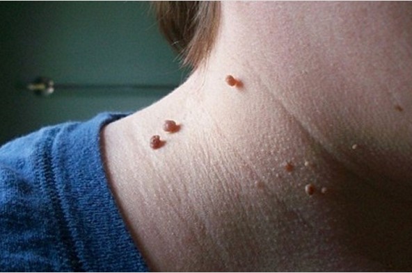 LO SAPEVI CHE FIBROMI POSSONO SPARIRE CON UN METODO VELOCISSIMO E NATURALE: ECCO COME FARE - 16/02/2016