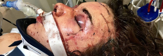 AGGREDITA E PICCHIATA DAL COINQUILINO CONOSCIUTO 2 SETTIMANE PRIMA: E' IN COMA - 21/02/2016