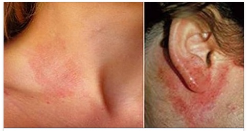 DERMATITE, NAUSEA E SPOSSATEZZA: SE AVETE QUESTI SINTOMI FATE ATTENZIONE - ECCO DI COSA SI TRATTA - 05/03/2016