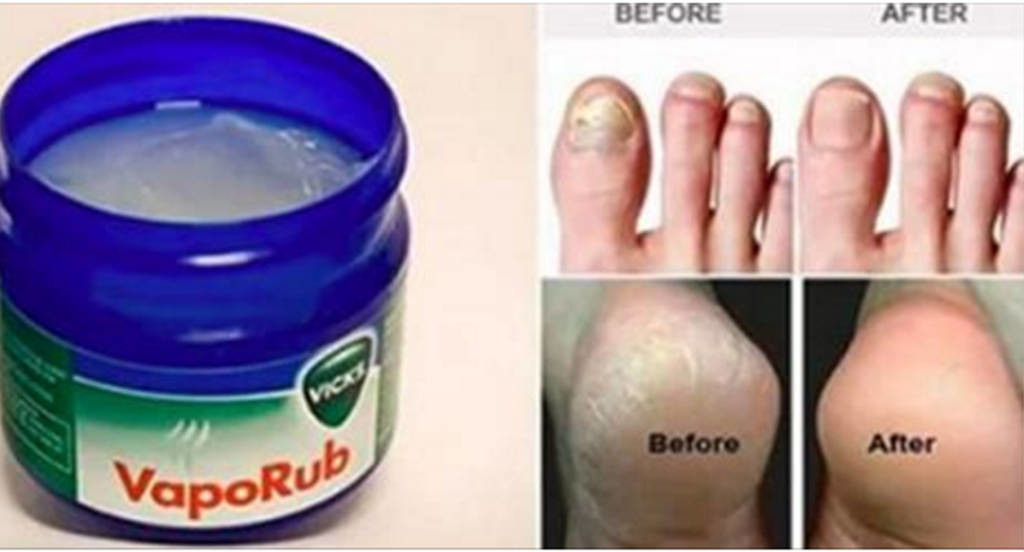 HAI MAI PROVATO AD APPLICARE IL VICS VAPORUB SUI CALLI DEI PIEDI? GLI USI CHE HAI SEMPRE IGNORATO - 17/03/2016