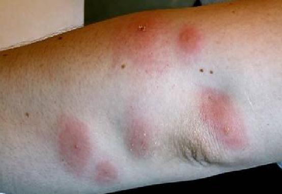 IL VIRUS E' ARRIVATO IN ITALIA, PRIMO CASO DI CONTAGIO - 05/09/2016