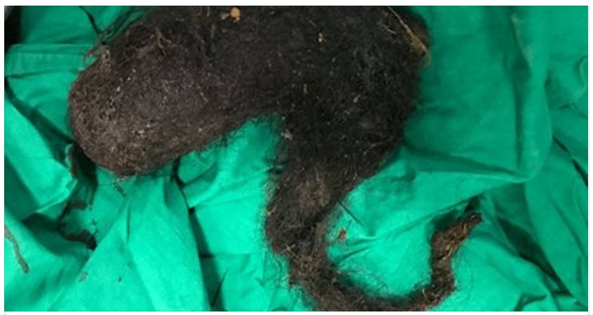 ECCO COSA C'ERA NELLO STOMACO DI UNA RAGAZZA ''SEMBRAVA UN TUMORE, POI ABBIAMO VISTO LA CODA...'' - 28/12/2016