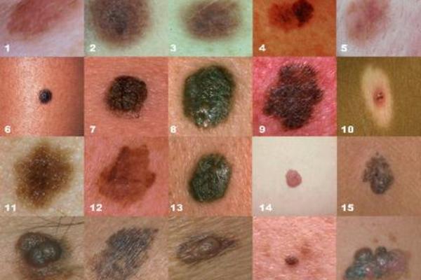 ECCO COME IDENTIFICARE E PREVENIRE I TUMORI DELLA PELLE - 13/06/2017