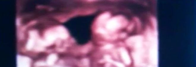 LA MAMMA FA SESSO CON DUE UOMINI: ''LE GEMELLE AVRANNO DUE PAPA' DIFFERENTI'' - 14/05/2015