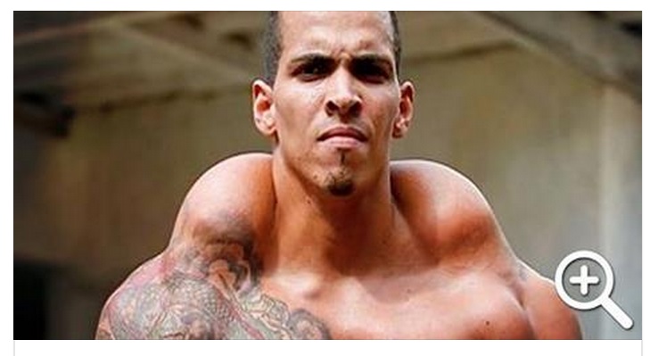 VOLEVA SOMIGLIARE A HULK E APPARIRE FORZUTO, RISCHIA L'AMPUTAZIONE - FOTO SHOCK - 10/05/2015