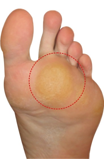 CALLI ADDIO: ECCO IL BENDAGGIO FAI DA TE CON 2 CIBI CHE AVETE IN CUCINA: ECCO QUALI - 19/07/2015