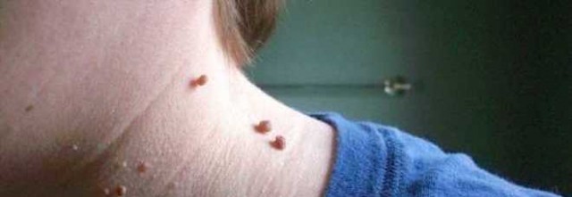 PORRI E PEDUNCOLI SUL COLLO? ECCO IL METODO TUTTO NATURALE PER RIMUOVERLI DA SOLI - 06/11/2015
