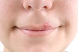 I RIMEDI PER ELIMINARE L'HERPES - ECCO COME ELIMINARLO VELOCEMENTE - 10/11/2015