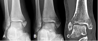 RIPARA E RIGENERA LE OSSA: LA SOLUZIONE CONTRO L'OSTEOPOROSI - 04/01/2016