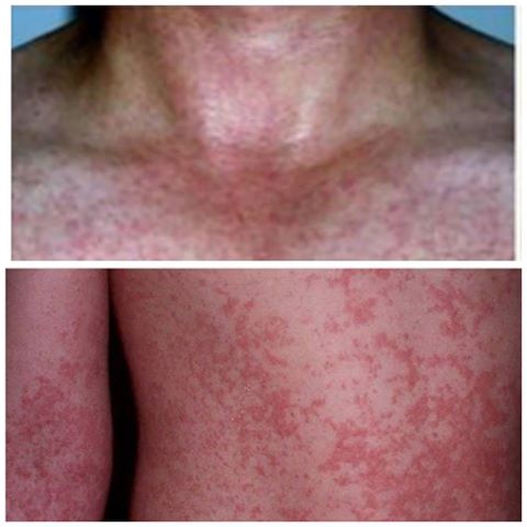 ATTENZIONE - IL TEMUTO VIRUS 'ZIKA' E' ARRIVATO IN EUROPA: 4 GLI ITALIANI GIA' CONTAGGIATI DAL VIRUS - 25/01/2016