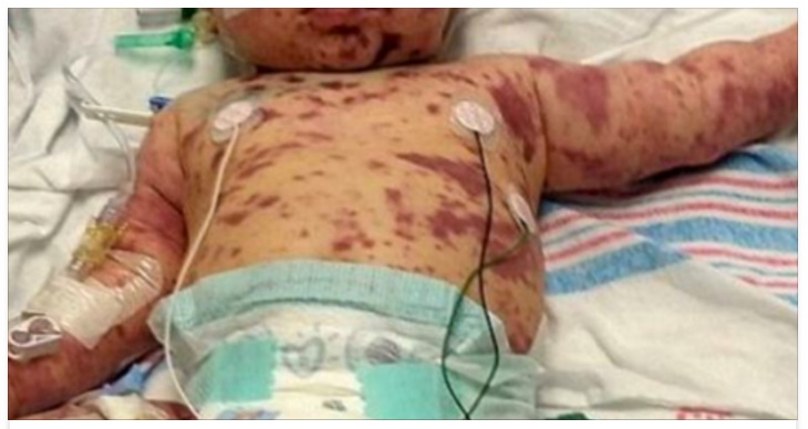 MENINGITE: ECCO COSA STA SUCCEDENDO IN ITALIA: L'AVVISO DEGLI ESPERTI ''ECCO COME SI PUO' TRASMETTERE'' - 11/02/2017