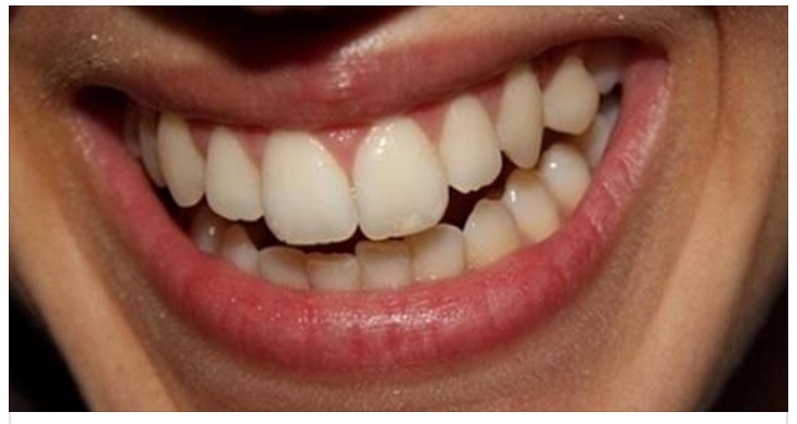 LA RICERCA SCIENTIFICA SHOCK: ''HAI I DENTI COSI'? ECCO PERCHE' MORIRAI PRIMA'' - 18/02/2017