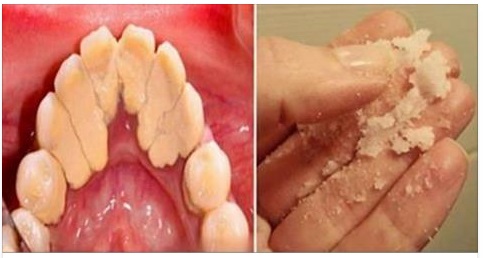 ECCO UN TRUCCO CASALINGO PER RIMUOVERE IL TARTARO VELOCEMENTE DAI DENTI - 06/04/2017