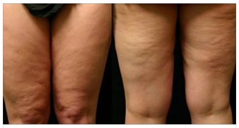UN BICCHIERE PRIMA DI ANDARE A LETTO: ECCO COME SCONFIGGERE LA CELLULITE: ECCO IL MODO EFFICACE FAI DA TE - 24/05/2017