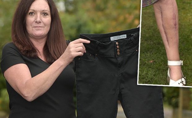 UNA DONNA HA RISCHIATO L'AMPUTAZIONE E LA VITA PER COLPA DEI JEANS TROPPO STRETTI - 30/05/2017