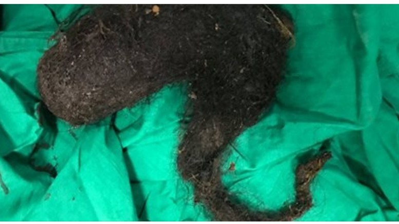 ECCO COSA C'ERA NELLO STOMACO DI UNA RAGAZZA ''SEMBRAVA UN TUMORE, POI ABBIAMO VISTO LA CODA'' - 13/06/2017