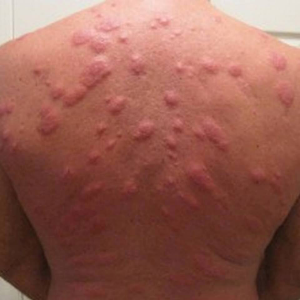 ROMA - UNA VERA INVASIONE CHE STA COLPENDO: SCATTA L'ALLARME DI FARE MOLTA ATTENZIONE - 13/06/2017