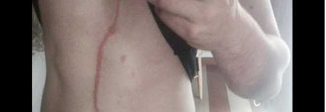UN RAGNO SOTTO PELLE LO RIEMPIE DI CICATRICI: LUI SCATTA LE FOTO E LE PUBBLICA SU FB - GUARDA - 05/12/2014