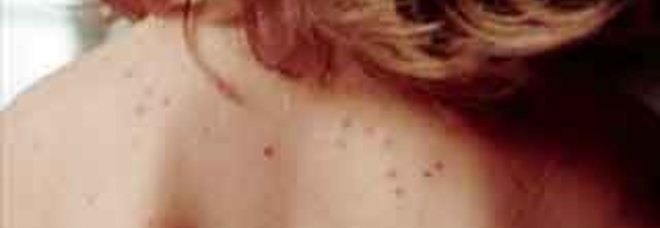 IL VIRUS DEL MORBILLO PUÒ SCONFIGGERE IL CANCRO: I RISULTATI SORPRENDENTI DI UNO STUDIO AMERICANO - 05/07/2014