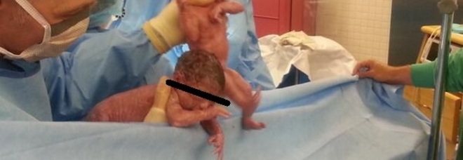 LE GEMELLINE SONO NATE TENENDOSI PER MANO: UN ALTRO CASO NELLO STESSO OSPEDALE - 06/07/2014