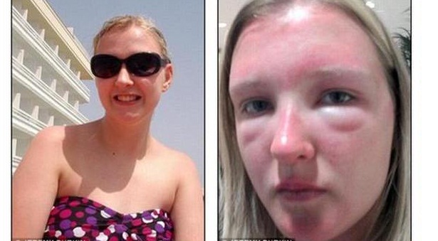 UNA RAGAZZA SI SFIGURA IL VISO A CAUSA DI OCCHIALI DA SOLE ACQUISTATI SU UNA BANCARELLA - 02/07/2014