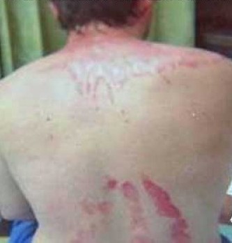 L'UOMO CHE PRENDE FUOCO A CAUSA DI UNA CREMA SOLARE MENTRE FA IL BARBECUE - FOTO - 04/07/2014