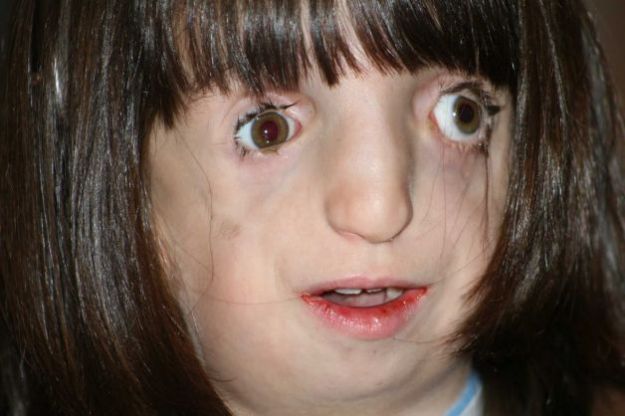 CLARA, LA BAMBINA DEFORME CHE VUOLE ESSERE COME LE ALTRE BAMBINE - FOTO - 14/07/2014