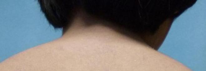 BIMBO DI 11 ANNI ALLERGICO ALL'IPAD, SCATTA L'ALLARME: ''SFOGO ENORME SULLA PELLE'' - 15/07/2014