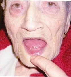 LA DONNA DI OLTRE 90 ANNI A CUI SONO RICRESCIUTI I DENTI - FOTO - 29/09/2014