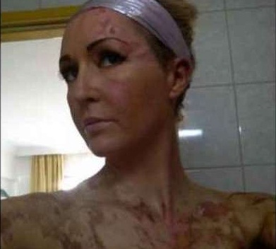 UN PIATTO FLAMBE' AL RISTORANTE CHE USTIONA MOGLIE E MARITO DURANTE L'ANNIVERSARIO - FOTO - 29/09/2014