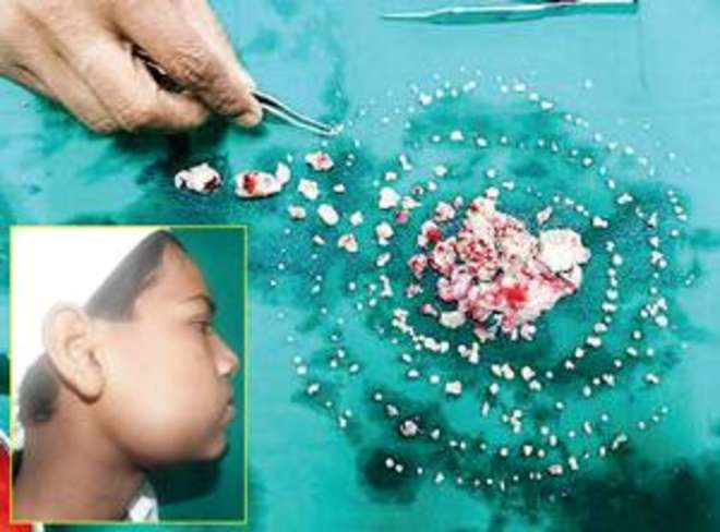 MEDICI ESTRAGGONO 232 DENTI DALLA BOCCA DI UN 17ENNE: ''AVEVA FORTI DOLORI'' - FOTO - 24/07/2014