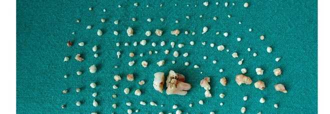 LA BAMBINA DI SETTE ANNI HA 202 DENTI. IL DENTISTA CHOC: ''COLPA DI UN TUMORE'' - FOTO - 17/01/2015
