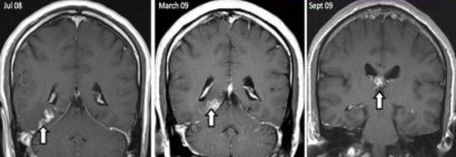 HA MAL DI TESTA E CONVULSIONI, MEDICI SCOPRONO UN PARASSITA DI 10 CM NEL SUO CERVELLO - 21/11/2014