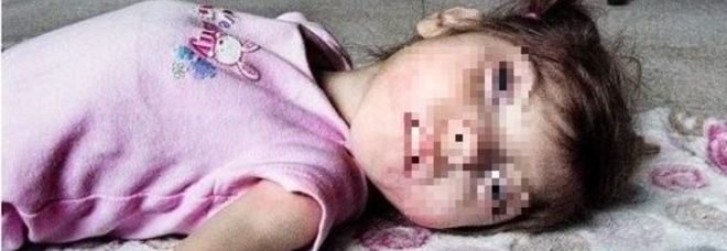 GABBY, HA 9 ANNI MA DIMOSTRA POCHI MESI: ''HA LA SINDROME DI BENJAMIN BUTTON'' - 28/01/2015