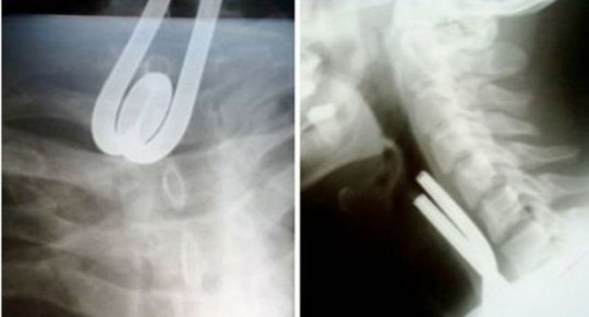 VA IN OSPEDALE CON UN FORTE MAL DI GOLA: I MEDICI FANNO UNA SCOPERTA SCIOCCANTE - 14/01/2015