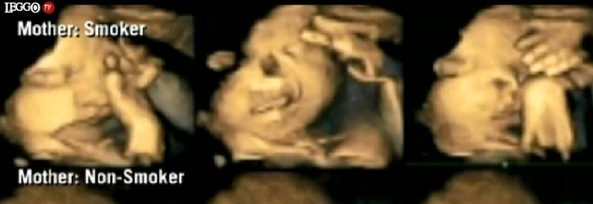 SE CONOSCETE UNA DONNA CHE FUMA IN GRAVIDANZA, FATELE VEDERE QUESTE FOTO - 25/03/2015